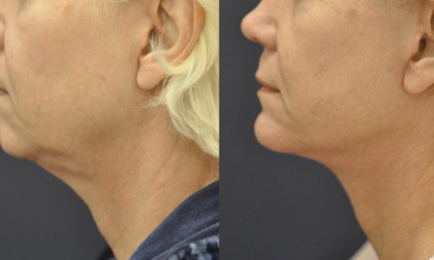 Facelift, Chin Implant