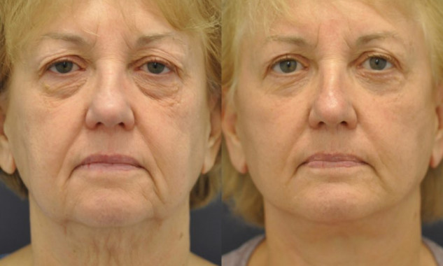 Facelift, Chin Implant, Upper & Lower Eyelids