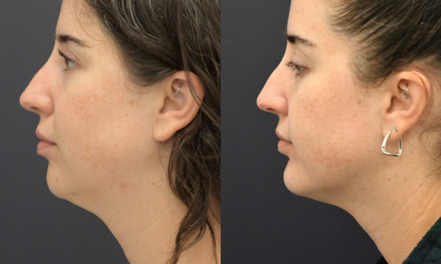 Chin Implant