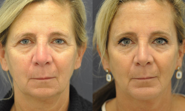 Chin Implant, Forehead lift