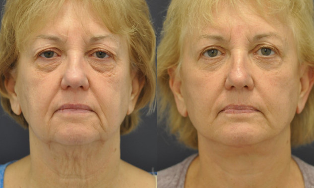 Facelift, Chin Implant, Upper & Lower Eyelids, Fat Transfer, Laser