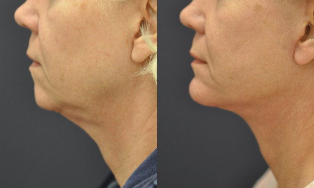 Facelift, Chin Implant