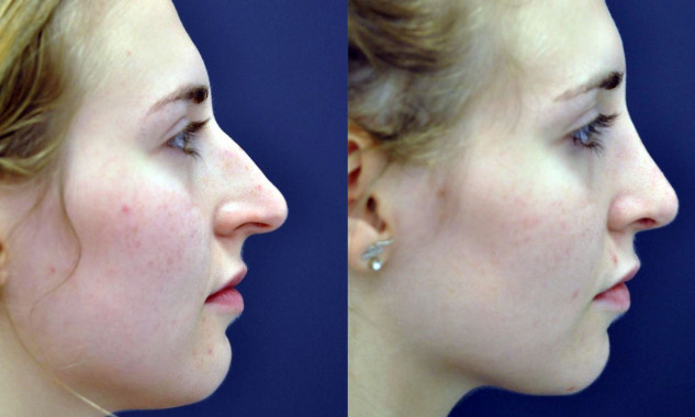Rhinoplasty
