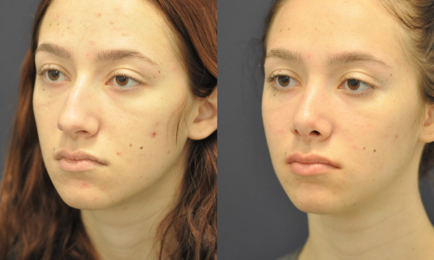 Rhinoplasty