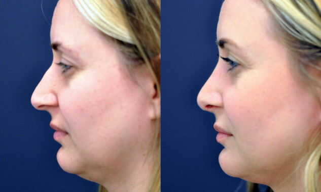 Rhinoplasty
