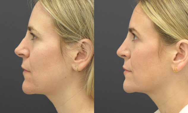 Rhinoplasty